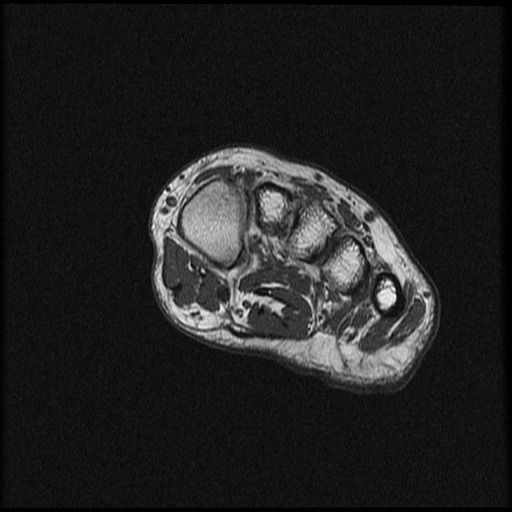 File:Chondroblastoma - midfoot (Radiopaedia 64831-73765 Short axis T1 20).jpg