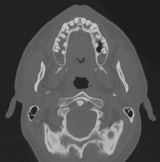 Chondrosarcoma (clivus) (Radiopaedia 46895-51425 Axial bone window 79).png