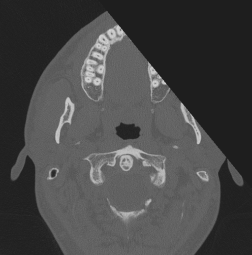 Chondrosarcoma (clivus) (Radiopaedia 46895-51425 Axial bone window 83).png