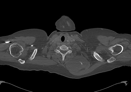 Chondrosarcoma - chest wall (Radiopaedia 65192-74199 Axial bone window 2).jpg