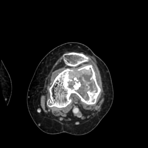 Chondrosarcoma - femur (Radiopaedia 64187-72954 Axial with contrast 45).jpg