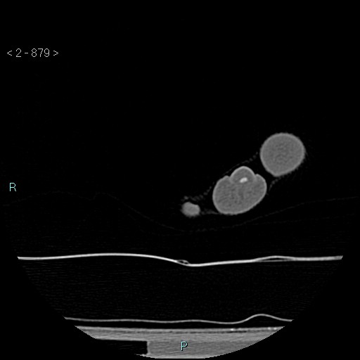 File:Chondrosarcoma - phalanx (Radiopaedia 69047-78812 Axial bone window 133).jpg
