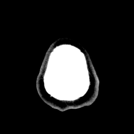 File:Chondrosarcoma - sphenoid wing (Radiopaedia 58259-67828 Axial non-contrast 28).jpg