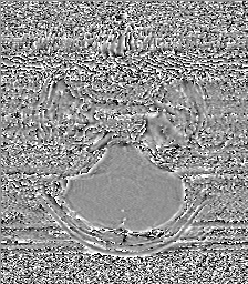 Chondrosarcoma - sphenoid wing (Radiopaedia 58259-67947 Axial SWI 17).jpg
