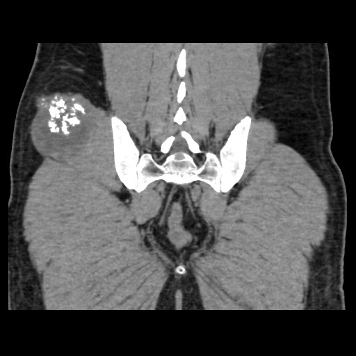 Chondrosarcoma of iliac wing (Radiopaedia 63861-72599 Coronal non-contrast 91).jpg