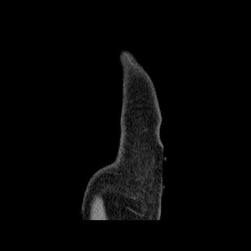 Chondrosarcoma of iliac wing (Radiopaedia 63861-72599 F 8).jpg
