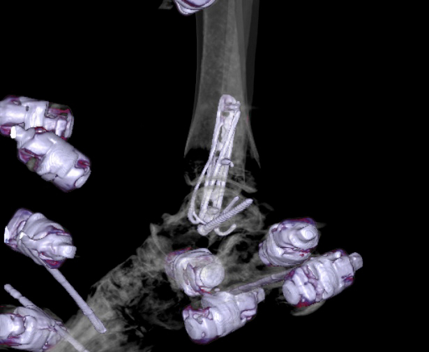 File:Chopart fracture (Radiopaedia 35347-36861 3D MPR bone window 13).jpg