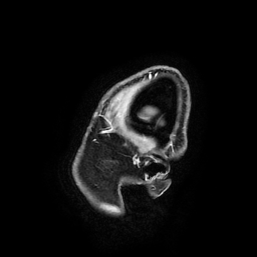 File:Chordoid glioma of third ventricle (Radiopaedia 91612-109340 F 20).jpg