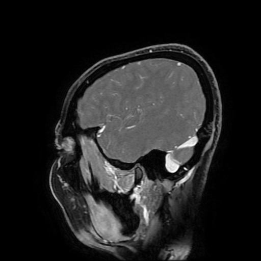 Chordoid glioma of third ventricle (Radiopaedia 91612-109340 F 50).jpg