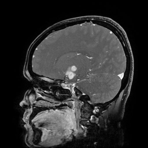 File:Chordoid glioma of third ventricle (Radiopaedia 91612-109340 F 90).jpg