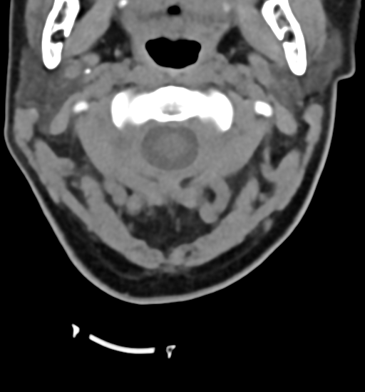 File:Chordoma (C4 vertebra) (Radiopaedia 47561-52188 Axial non-contrast 11).png