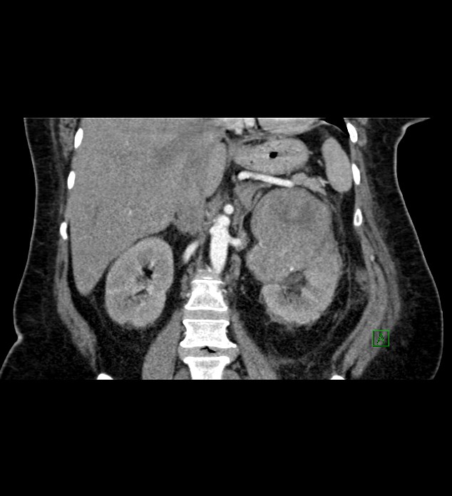 Chromophobe renal cell carcinoma (Radiopaedia 84239-99519 C 52).jpg