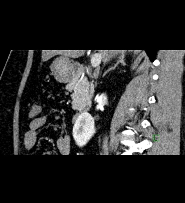Chromophobe renal cell carcinoma (Radiopaedia 84286-99573 F 101).jpg