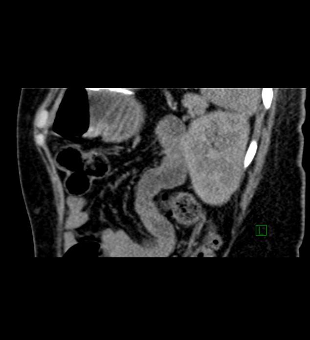 Chromophobe renal cell carcinoma (Radiopaedia 84290-99582 D 23).jpg