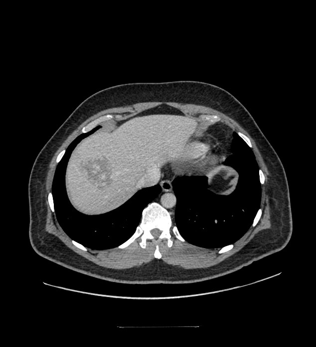 Chromophobe renal cell carcinoma (Radiopaedia 84337-99644 C 18).jpg