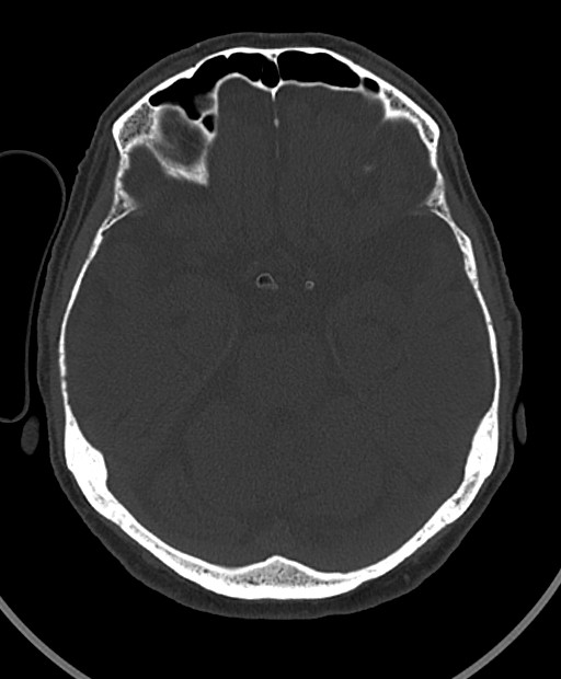 Chronic bilateral subdural hygroma (Radiopaedia 85801-101623 Axial bone window 81).jpg
