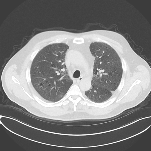 Chronic hypersensitivity pneumonitis (Radiopaedia 48107-52922 Axial lung window 24).png
