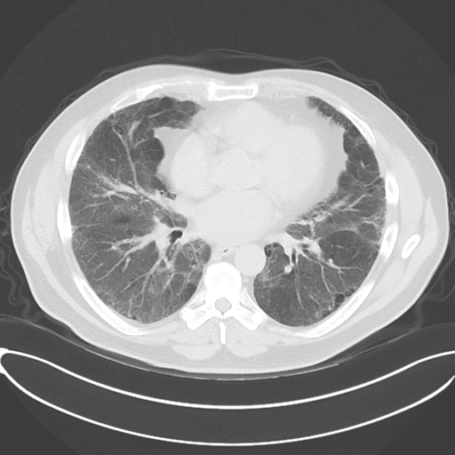 Chronic hypersensitivity pneumonitis (Radiopaedia 48107-52922 Axial lung window 36).png