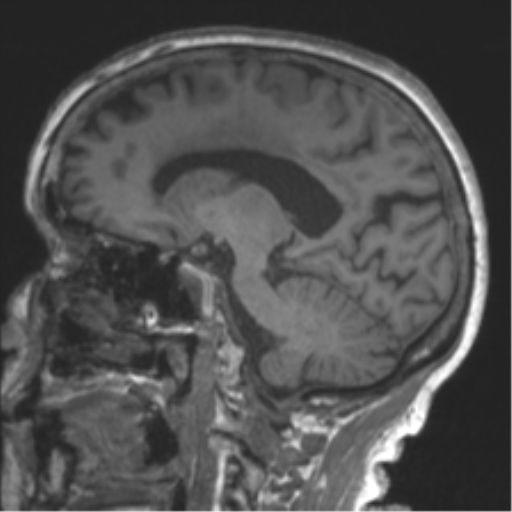 Chronic hypertensive encephalopathy (Radiopaedia 39993-42482 Sagittal T1 41).png