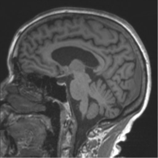 Chronic hypertensive encephalopathy (Radiopaedia 39993-42482 Sagittal T1 45).png