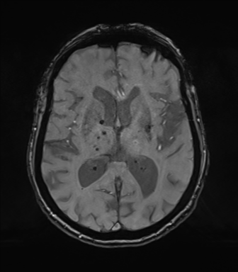 Chronic hypertensive encephalopathy (Radiopaedia 72844-83495 Axial SWI magnitude 45).png