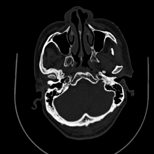 File:Chronic invasive fungal sinusitis (Radiopaedia 91563-109286 Axial sinus 22).jpg