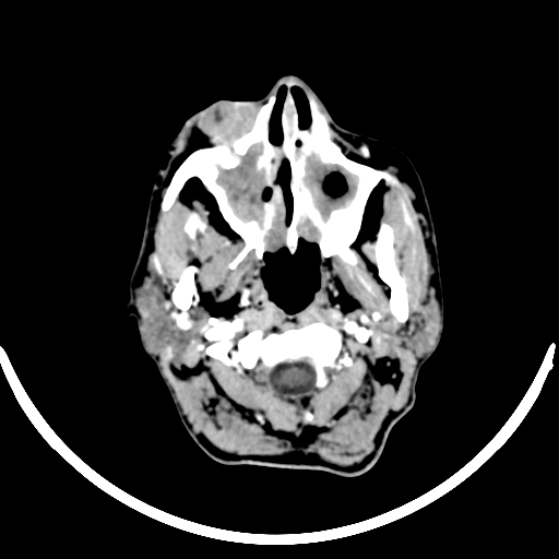 Chronic invasive fungal sinusitis with intraorbital and intracranial extension (Radiopaedia 56387-63046 B 30).jpg