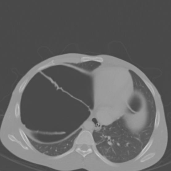 File:Chronic large bowel pseudo-obstruction (Radiopaedia 43181-46492 Axial bone window 29).jpg