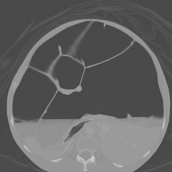 Chronic large bowel pseudo-obstruction (Radiopaedia 43181-46492 Axial bone window 73).jpg