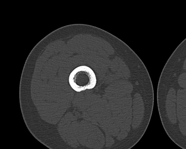 Chronic ostemyelitis of the femur with long sinus tract (Radiopaedia 74947-85982 Axial bone window 79).jpg