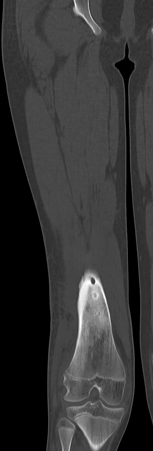 Chronic ostemyelitis of the femur with long sinus tract (Radiopaedia 74947-85982 Coronal bone window 50).jpg