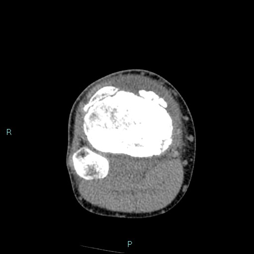 Chronic osteomyelitis (with Brodie abscess) (Radiopaedia 76405-88111 A 87).jpg