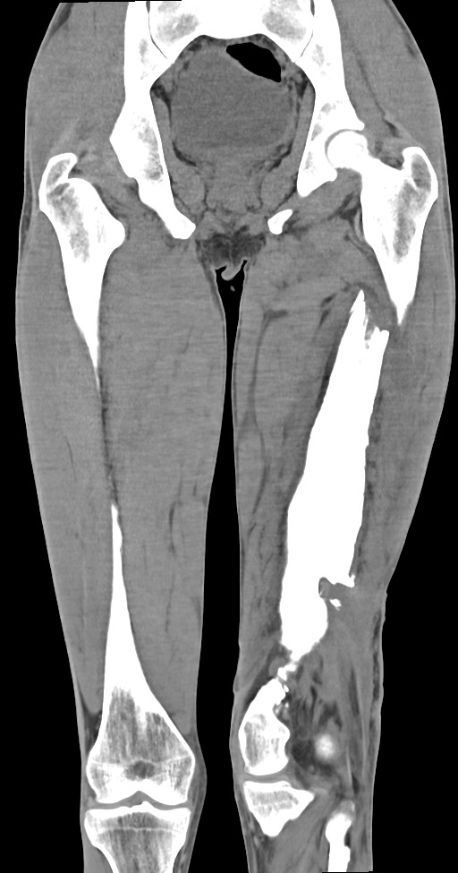 Chronic osteomyelitis (with sequestrum) (Radiopaedia 74813-85822 E 33).jpg