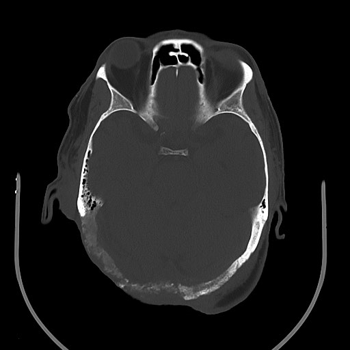 Chronic osteomyelitis - calvarial (severe) (Radiopaedia 69668-79616 Axial bone window 38).jpg