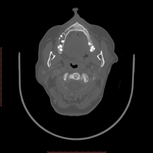 Chronic osteomyelitis - maxilla (Radiopaedia 23783-23927 Axial bone window 75).jpg