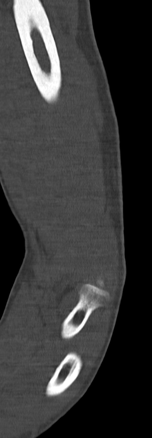 Chronic osteomyelitis of the distal humerus (Radiopaedia 78351-90971 Sagittal bone window 40).jpg