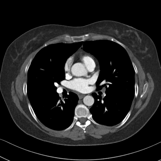 Chronic pulmonary embolus (Radiopaedia 39129-41341 Axial C+ CTPA 55).png