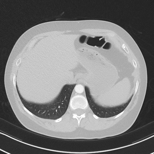 Chronic pulmonary embolus (Radiopaedia 39129-41341 Axial lung window 54).png