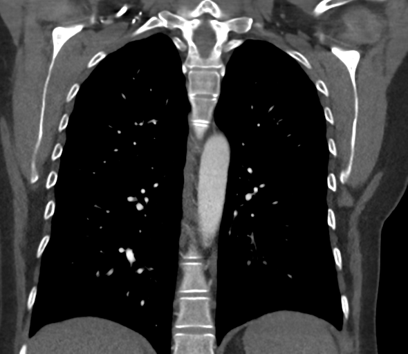 Chronic pulmonary embolus (Radiopaedia 39129-41341 Coronal C+ CTPA 58).png
