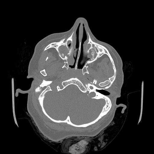 Chronic sinusitis with intra-sinus calcification (Radiopaedia 63919-72668 Axial bone window 51).jpg