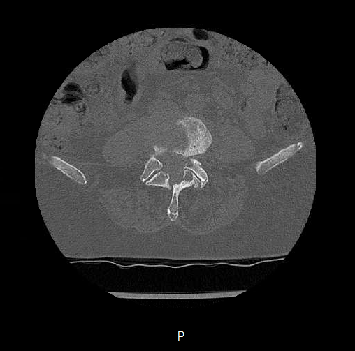Chronic spinal hematoma with cauda equina syndrome (Radiopaedia 75745-88197 Axial bone window 43).png