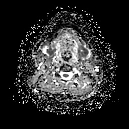 File:Chronic submandibular sialadenitis (Radiopaedia 61852-69885 Axial ADC 15).jpg