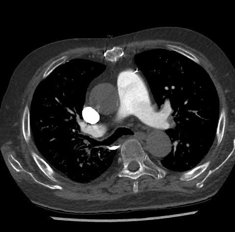 Chronic thromboembolic pulmonary disease (Radiopaedia 90694-108119 Axial C+ CTPA 39).jpg