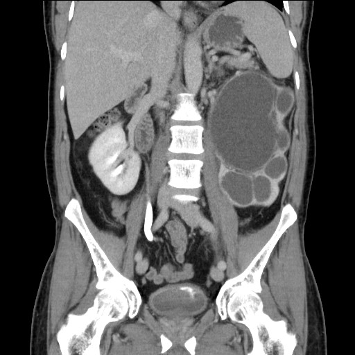 Chronic ureteropelvic junction obstruction (Radiopaedia 78365-90996 B 54).jpg