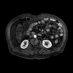 File:Cirrhosis and hepatocellular carcinoma in the setting of hemochromatosis (Radiopaedia 75394-86594 Axial T1 C+ fat sat 100).jpg