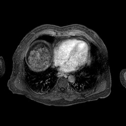 Cirrhosis and hepatocellular carcinoma in the setting of hemochromatosis (Radiopaedia 75394-86594 Axial T1 C+ fat sat 337).jpg