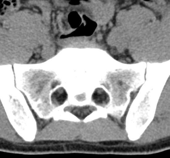 File:Clear cell meningoma - lumbar spine (Radiopaedia 60116-67691 Axial non-contrast 72).png