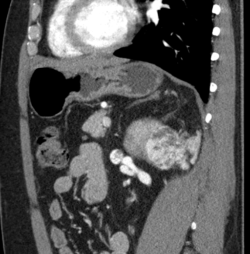 File:Clear cell renal cell carcinoma (Radiopaedia 61449-69393 D 37).jpg