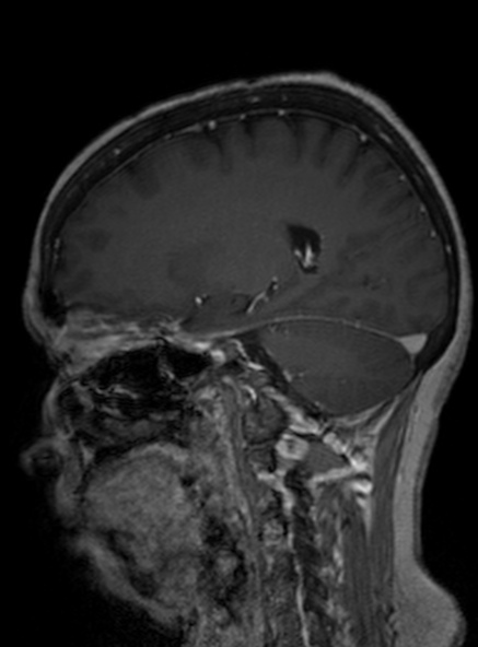 Clival meningioma (Radiopaedia 53278-59248 Sagittal T1 C+ 222).jpg
