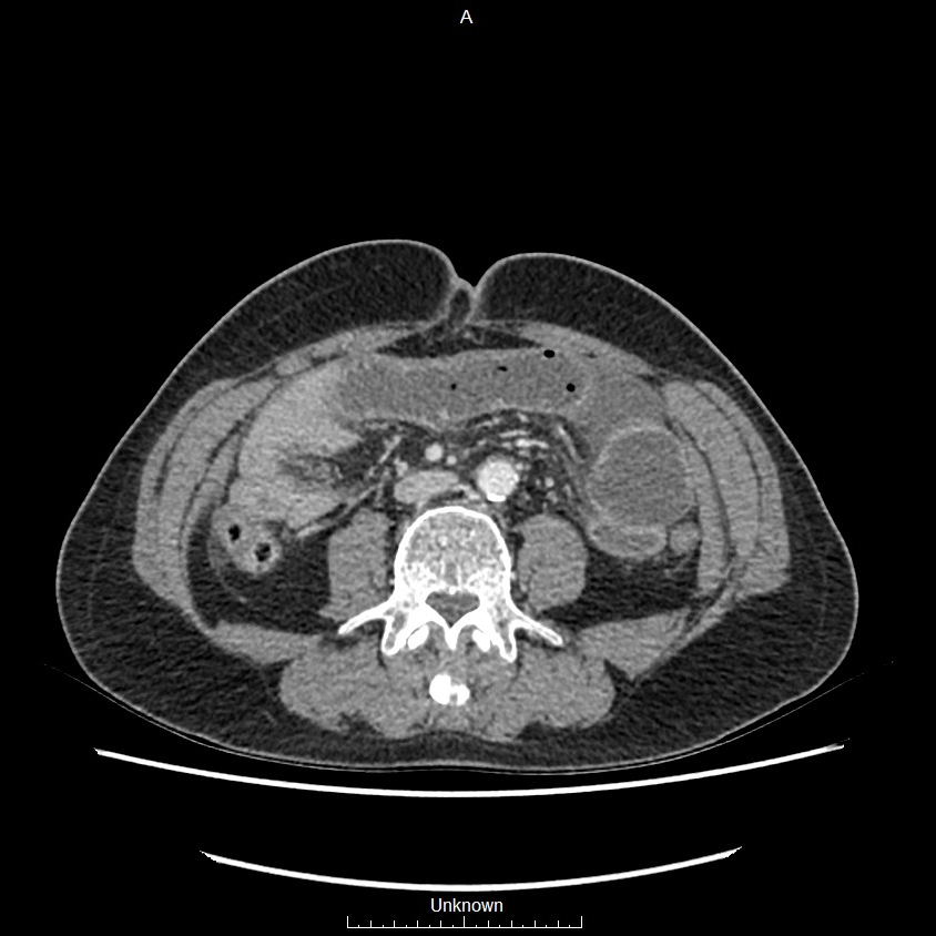 Closed loop bowel obstruction and ischemia (Radiopaedia 86959-103180 A 45).jpg